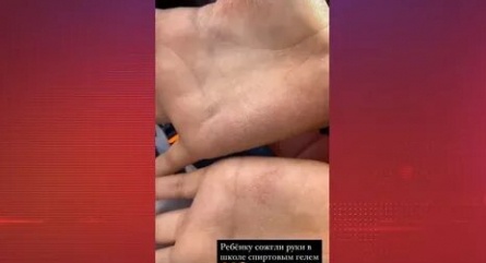 Дочери Бони сожгли ладони спиртовым гелем кадры Дочери Бони сожгли ладони спиртовым гелем кадры